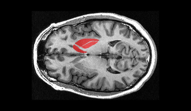 临床试验|干细胞疗法正式向人类帕金斯病宣战