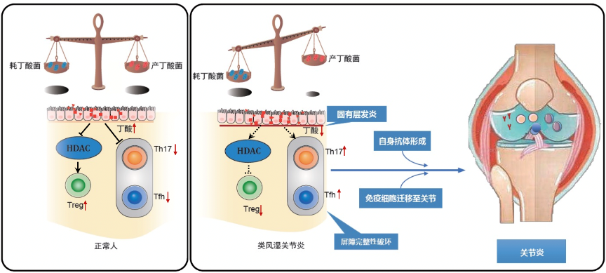 类风湿性关节炎机制图片