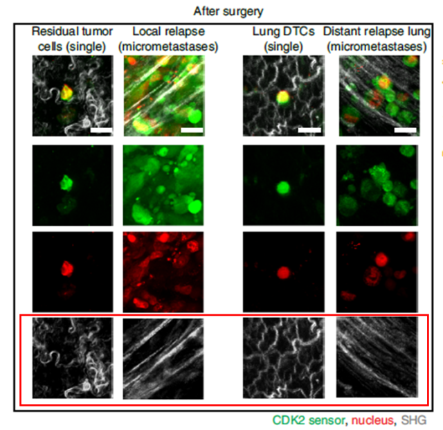 New breakthrough: This collagen can make tumor cells go dormant!