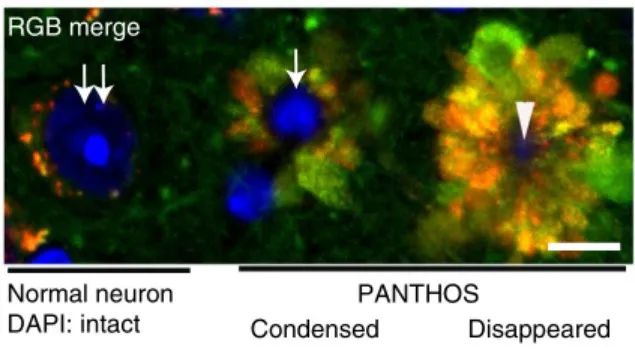 Nature: Amyloid beta is not the cause of Alzheimer's disease. 