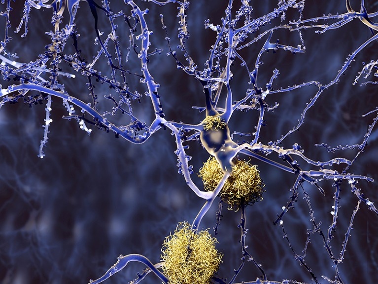 Computer illustration of amyloid plaques amongst neurons. Amyloid plaques are characteristic features of Alzheimer's disease.