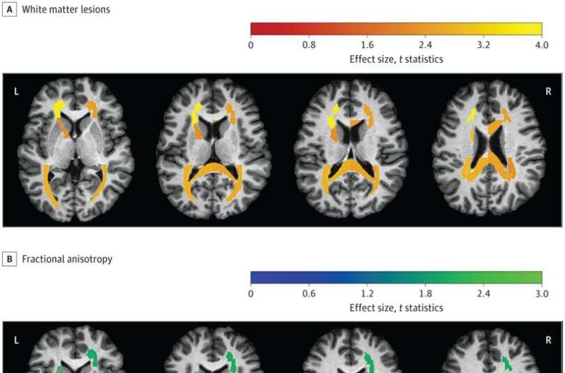 Keeping a tighter rein on blood pressure in adults over 50 is desirable for brain health