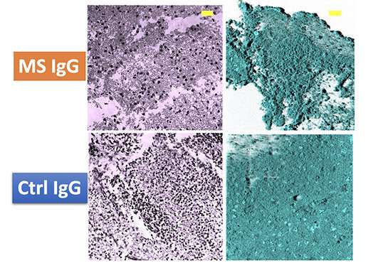 Study: multiple sclerosis blood antibodies found to be toxic to neurons