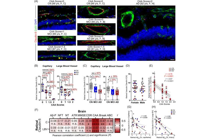 Study: Blood vessel damage could be an Alzheimer's driver